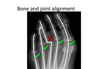 Bone Allignment Interpretation of musculoskeletal x rays | PPTX