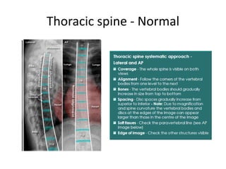 Thoracic Rotation Normal Interpretation of musculoskeletal x rays | PPTX
