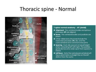 Thoracic Rotation Normal Interpretation of musculoskeletal x rays | PPTX