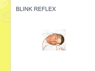 BLINK REFLEX
 