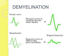 DEMYELINATION
 