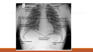 Reading Radiographs Interpretation of normal radiograph | PPTX