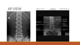 Roberts View Radiographs Interpretation of normal radiograph | PPTX
