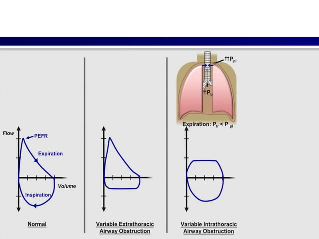 Interpretation Of Pulmonary Function Test PPTX Lung And Respiratory 