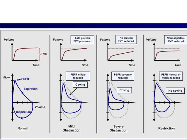 Interpretation of Pulmonary Function Test