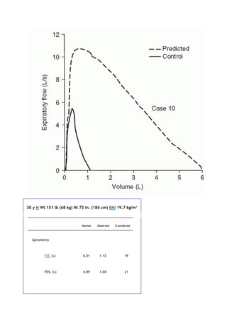 30 y M Wt 151 lb (68 kg) Ht 73 in. (186 cm) BMI 19.7 kg/m2
Normal Observed % predicted
Spirometry
FVC (L) 6.01 1.12*
19
FEV1 (L) 4.89 1.04*
21
 