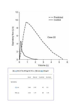 68 y M Wt 217 lb (99 kg) Ht 74 in. (188 cm) BMI 28 kg/m2
Normal Observed % predicted Post-dilator
Spirometry
FVC (L) 5.46 2.33*
43 2.2
FEV1 (L) 4.10 1.17*
28 1.19
 