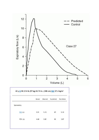 42 y M Wt 214 lb (97 kg) Ht 74 in. (188 cm) BMI 27.4 kg/m2
Normal Observed % predicted Post-dilator
Spirometry
FVC (L) 5.91 5.15 87 5.10
FEV1 (L) 4.68 3.82*
82 3.87
 