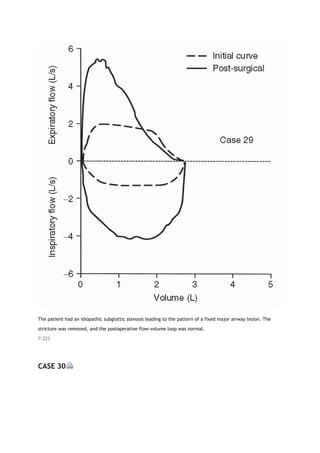The patient had an idiopathic subglottic stenosis leading to the pattern of a fixed major airway lesion. The
stricture was removed, and the postoperative flow-volume loop was normal.
P.222
CASE 30
 