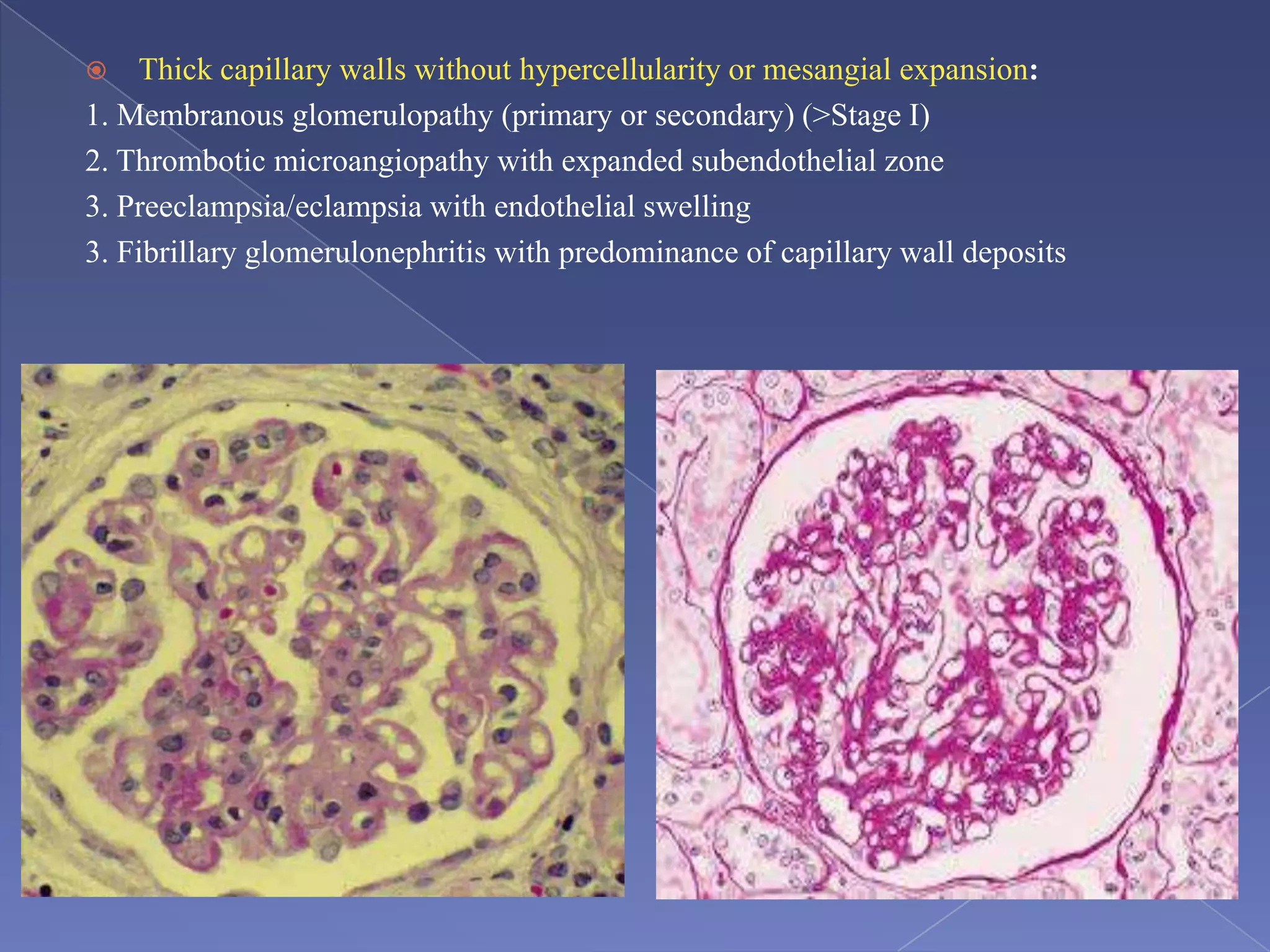  Thick capillary walls without hypercellularity or mesangial expansion:
1. Membranous glomerulopathy (primary or secondary) (>Stage I)
2. Thrombotic microangiopathy with expanded subendothelial zone
3. Preeclampsia/eclampsia with endothelial swelling
3. Fibrillary glomerulonephritis with predominance of capillary wall deposits
 