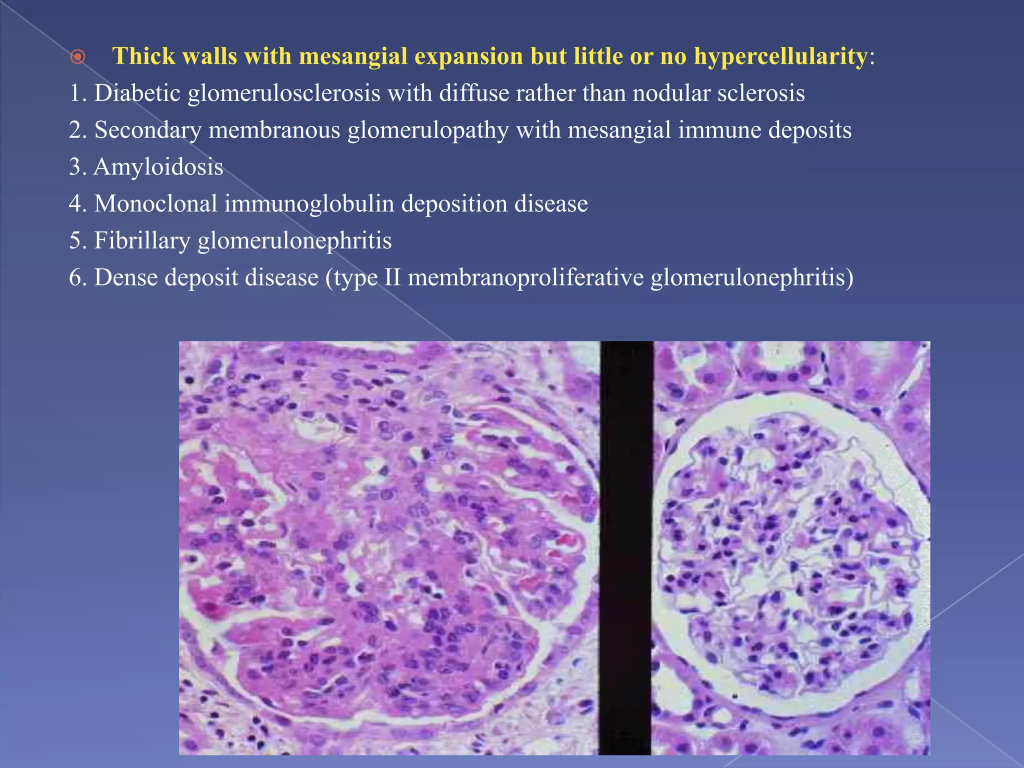  Thick walls with mesangial expansion but little or no hypercellularity:
1. Diabetic glomerulosclerosis with diffuse rather than nodular sclerosis
2. Secondary membranous glomerulopathy with mesangial immune deposits
3. Amyloidosis
4. Monoclonal immunoglobulin deposition disease
5. Fibrillary glomerulonephritis
6. Dense deposit disease (type II membranoproliferative glomerulonephritis)
 