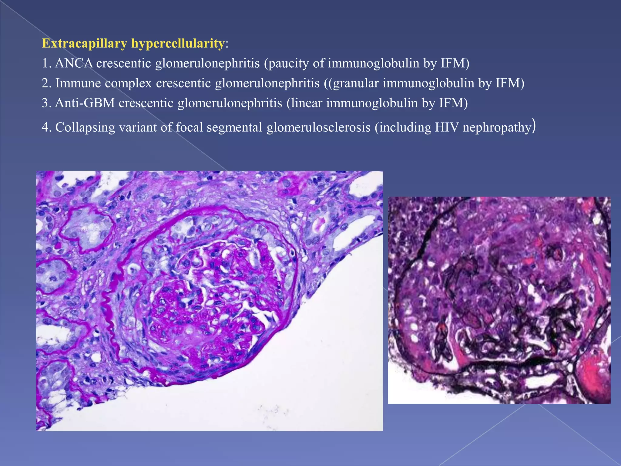 Extracapillary hypercellularity:
1. ANCA crescentic glomerulonephritis (paucity of immunoglobulin by IFM)
2. Immune complex crescentic glomerulonephritis ((granular immunoglobulin by IFM)
3. Anti-GBM crescentic glomerulonephritis (linear immunoglobulin by IFM)
4. Collapsing variant of focal segmental glomerulosclerosis (including HIV nephropathy)
 