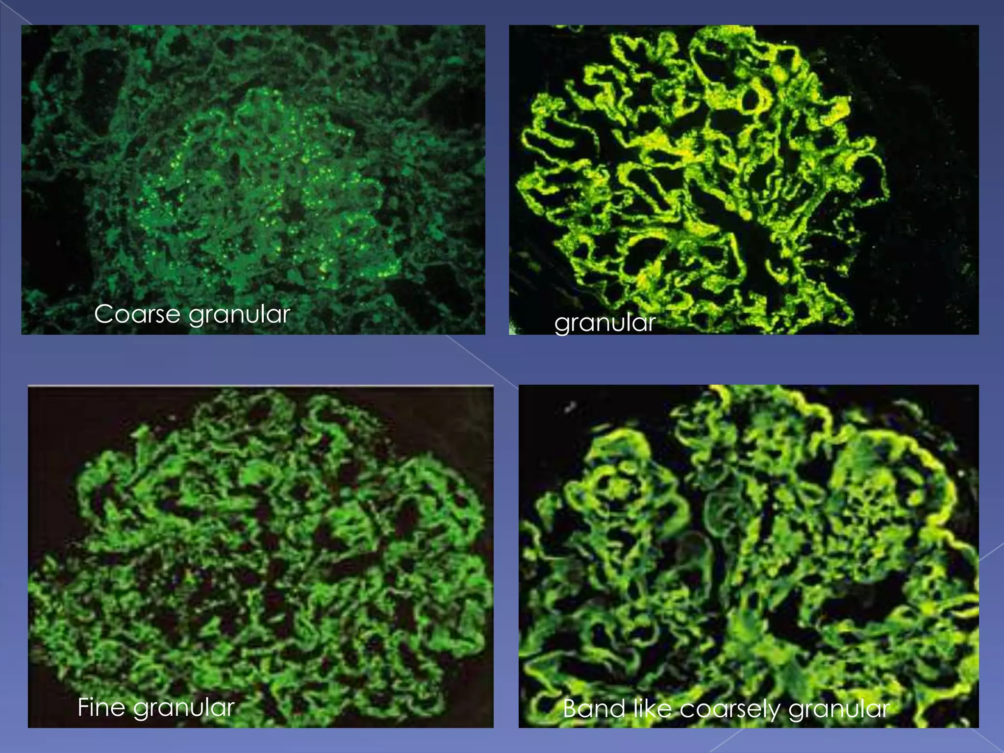 Coarse granular granular
Fine granular Band like coarsely granular
 