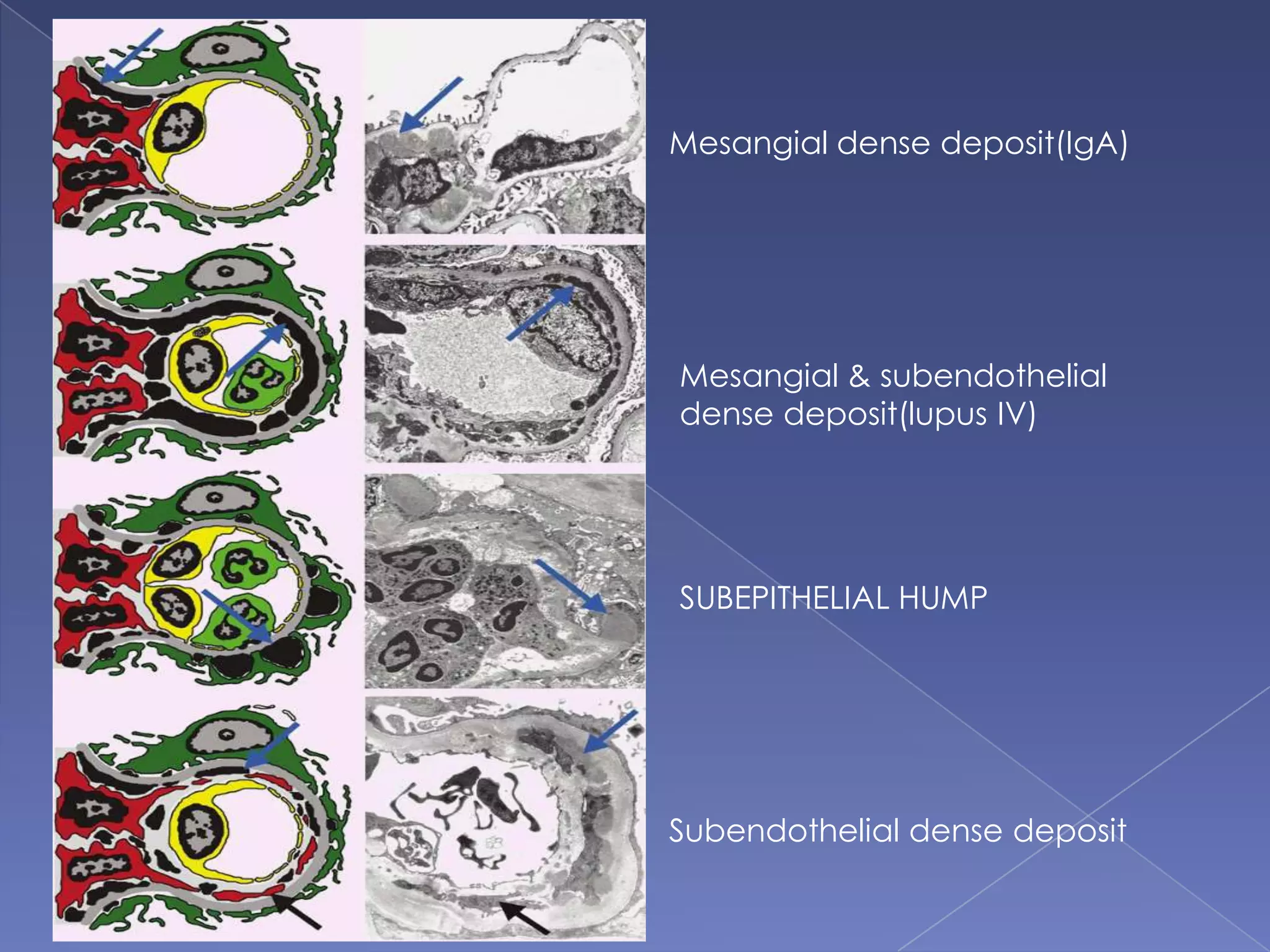 Mesangial dense deposit(IgA)
Mesangial & subendothelial
dense deposit(lupus IV)
SUBEPITHELIAL HUMP
Subendothelial dense deposit
 