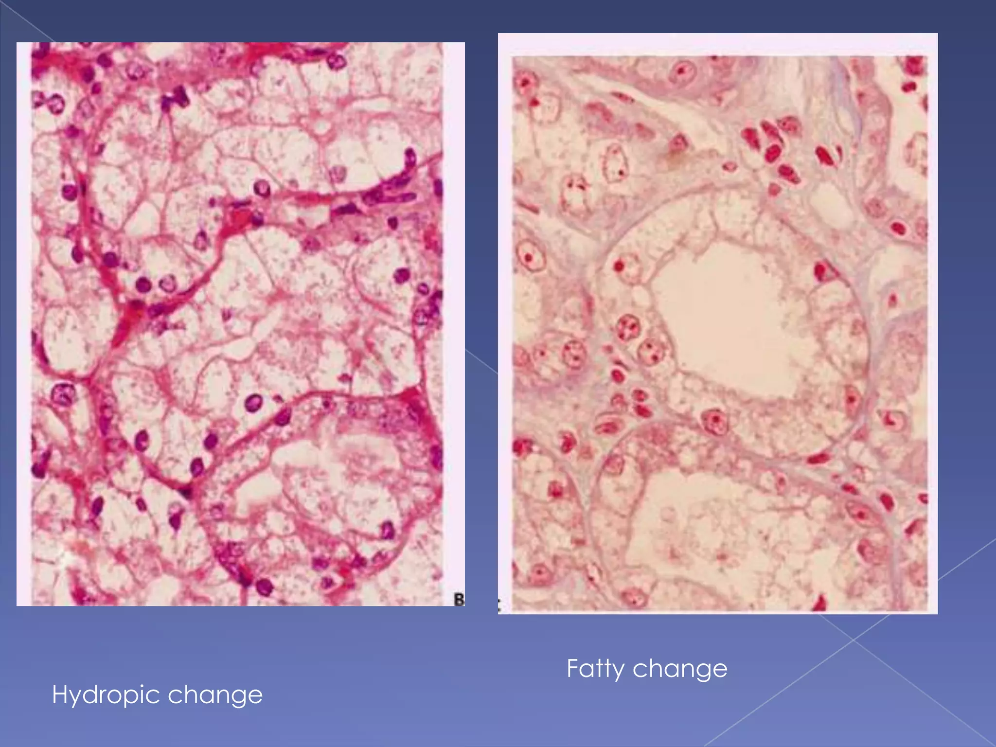 Hydropic change
Fatty change
 