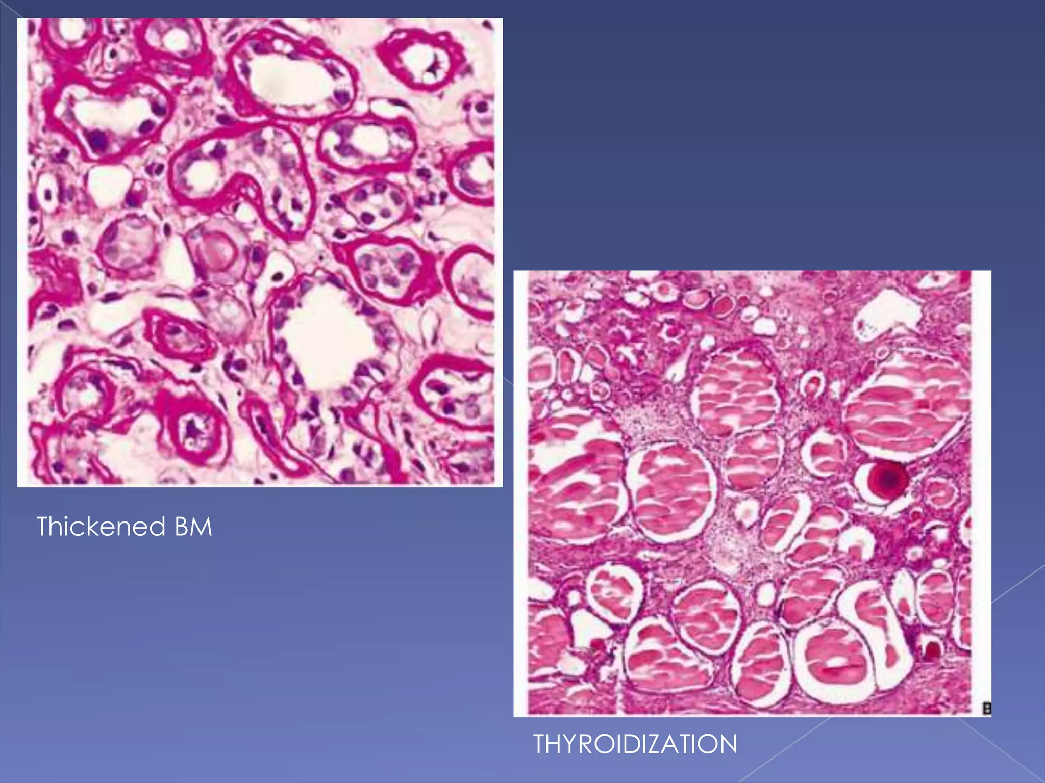 Thickened BM
THYROIDIZATION
 