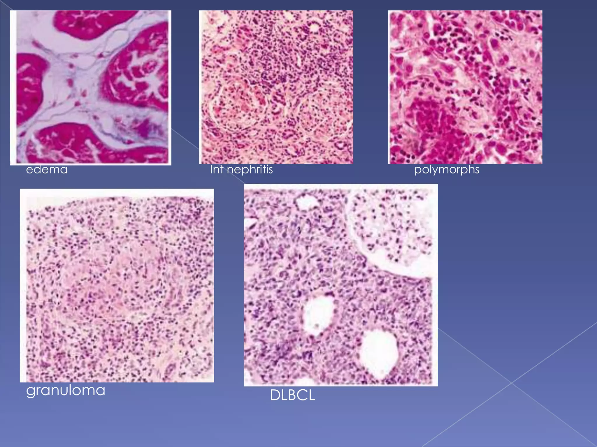 edema Int nephritis polymorphs
granuloma DLBCL
 