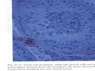 Causes of sloughing of immatureCauses of sloughing of immature
cellscells
VaricoceleVaricocele
Prior VasectomyPrior Vasect...