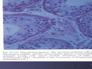 Spermatogenic mature arrestSpermatogenic mature arrest
One of the most prevalent causes of infertilityOne of the most prev...