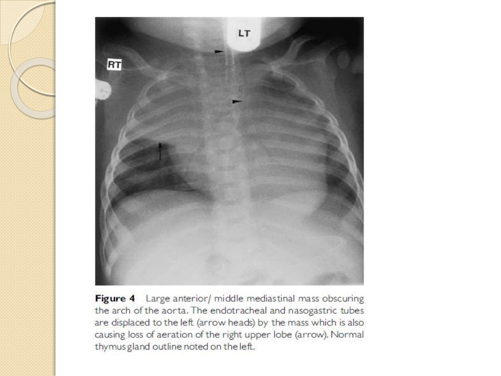 Interpretation of the paediatric chest x ray 1