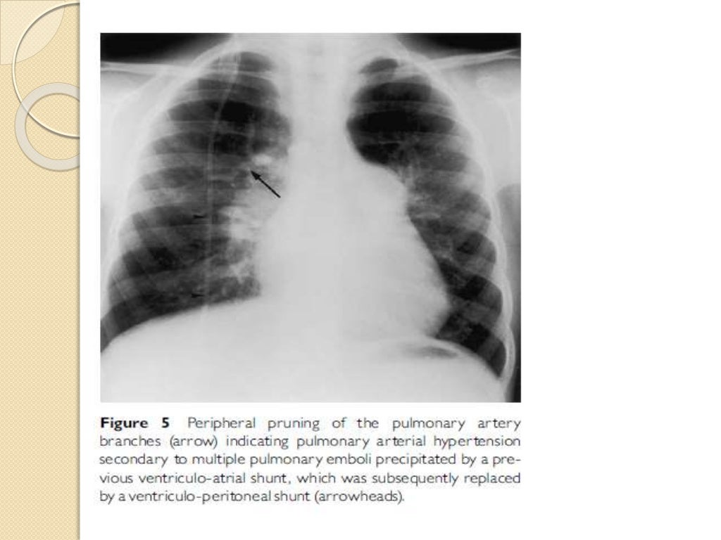 Interpretation of the paediatric chest x ray 1