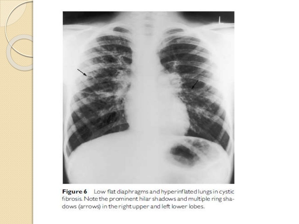 Interpretation of the paediatric chest x ray 1