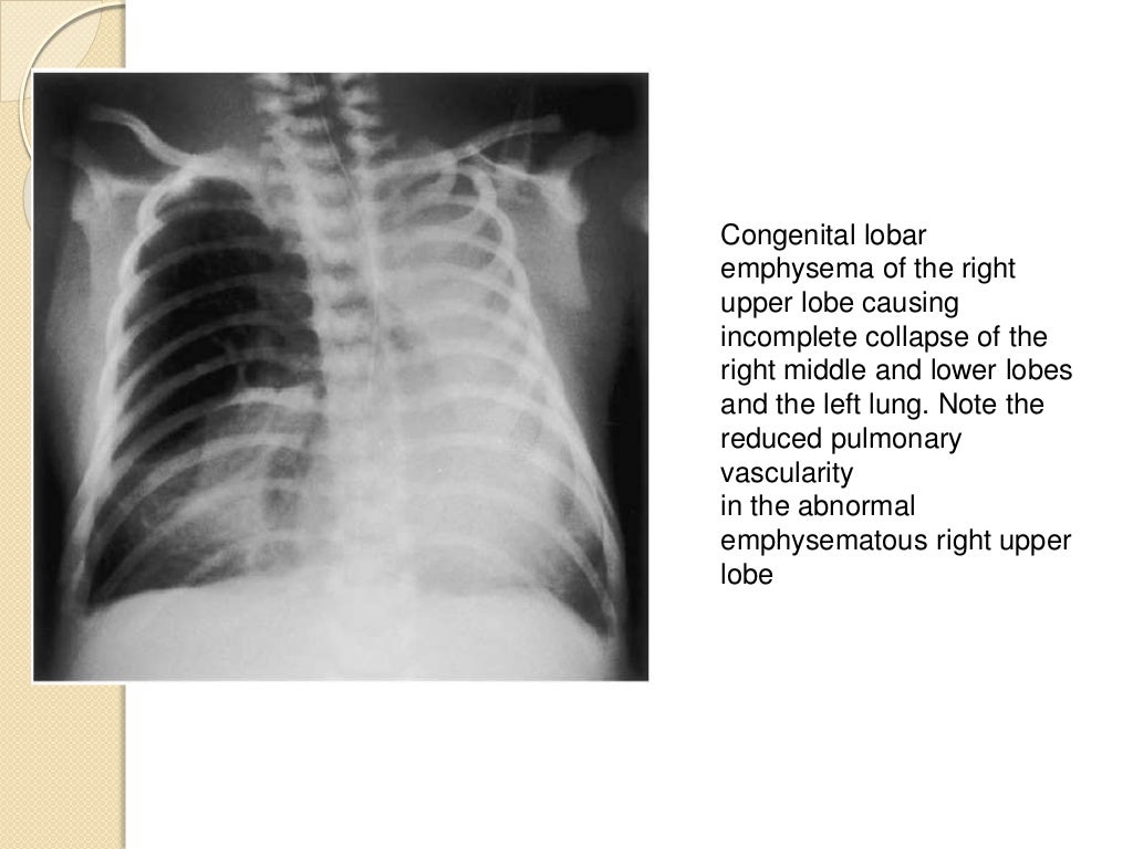 Interpretation of the paediatric chest x ray 1