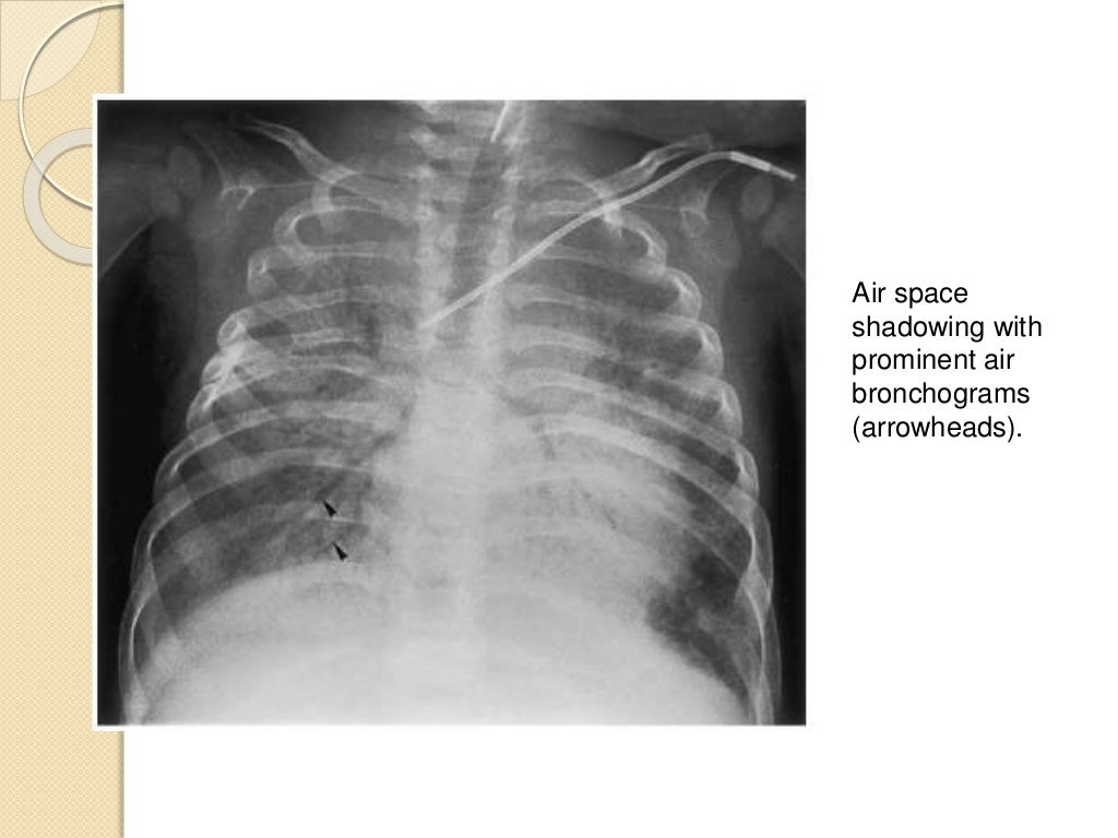 Interpretation of the paediatric chest x ray 1