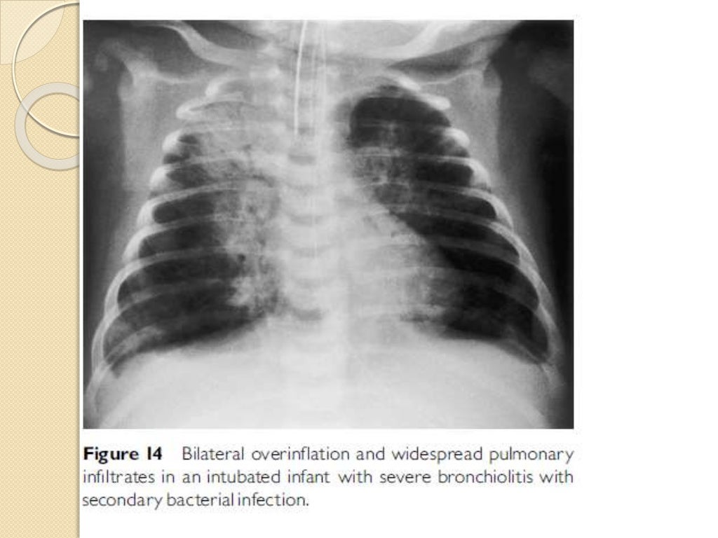 Interpretation of the paediatric chest x ray 1