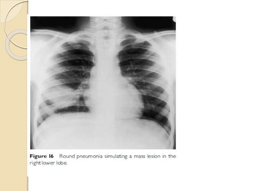 Interpretation of the paediatric chest x ray 1