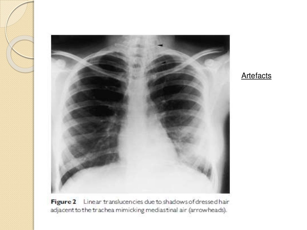 Interpretation of the paediatric chest x ray 1