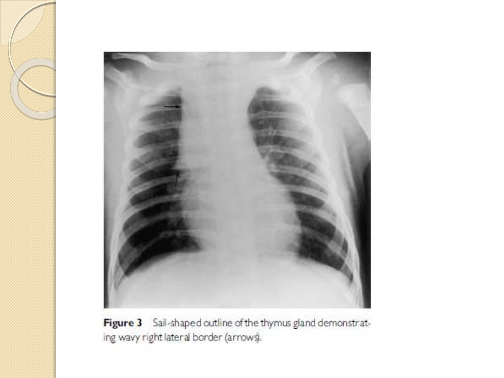 Interpretation of the paediatric chest x ray 1