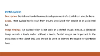 Splintered Scocket Interpretation of Trauma, Pulpal Lesions2026.pptx