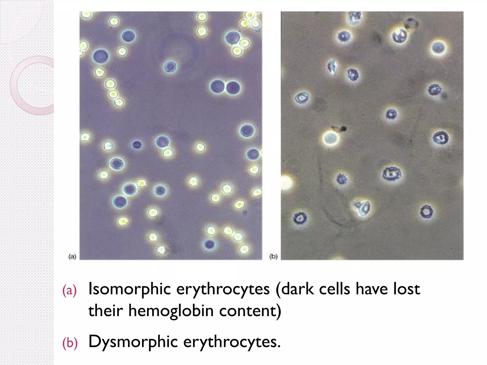 (a)

Isomorphic erythrocytes (dark cells have lost
their hemoglobin content)

(b)

Dysmorphic erythrocytes.

 