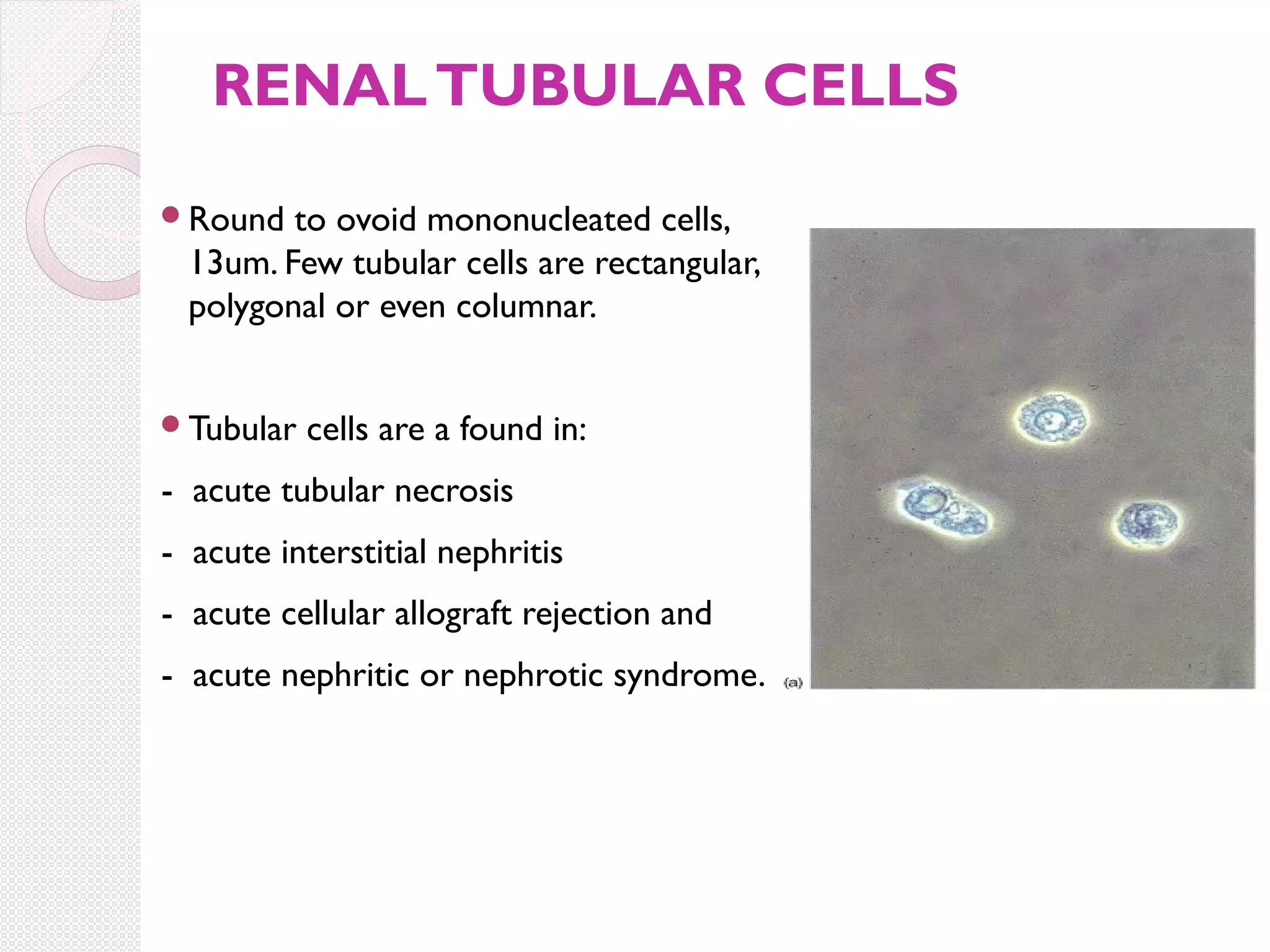 RENAL TUBULAR CELLS
Round

to ovoid mononucleated cells,
13um. Few tubular cells are rectangular,
polygonal or even columnar.

Tubular

cells are a found in:

- acute tubular necrosis
- acute interstitial nephritis
- acute cellular allograft rejection and
- acute nephritic or nephrotic syndrome.

 