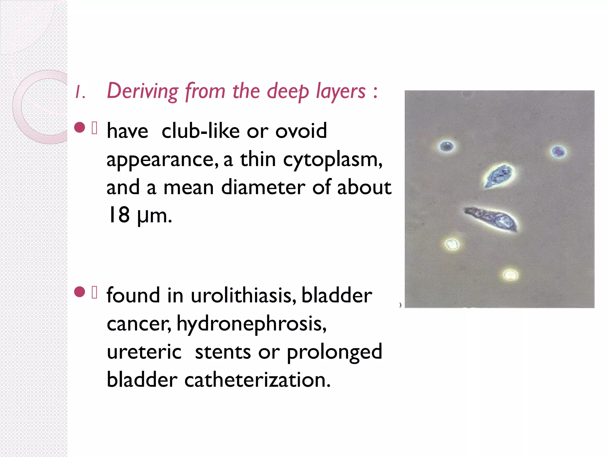 1.

Deriving from the deep layers :

.

have club-like or ovoid
appearance, a thin cytoplasm,
and a mean diameter of about
18 μm.

.

found in urolithiasis, bladder
cancer, hydronephrosis,
ureteric stents or prolonged
bladder catheterization.

 