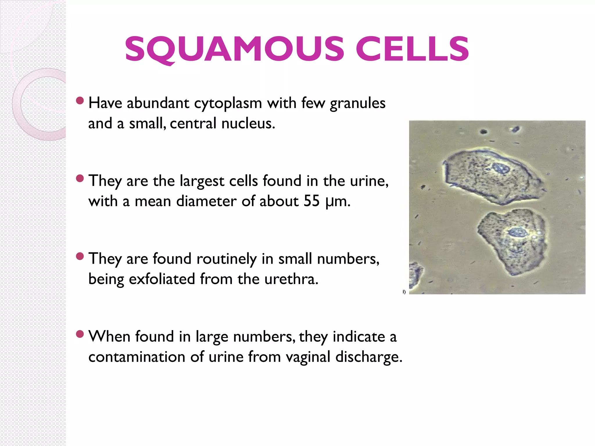 SQUAMOUS CELLS
Have

abundant cytoplasm with few granules
and a small, central nucleus.

They

are the largest cells found in the urine,
with a mean diameter of about 55 μm.

They

are found routinely in small numbers,
being exfoliated from the urethra.

When

found in large numbers, they indicate a
contamination of urine from vaginal discharge.

 