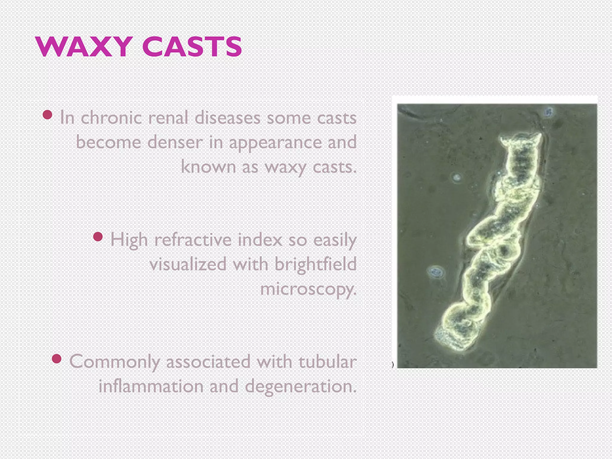 WAXY CASTS
 In

chronic renal diseases some casts
become denser in appearance and
known as waxy casts.
 High

refractive index so easily
visualized with brightfield
microscopy.

 Commonly

associated with tubular
inflammation and degeneration.

 