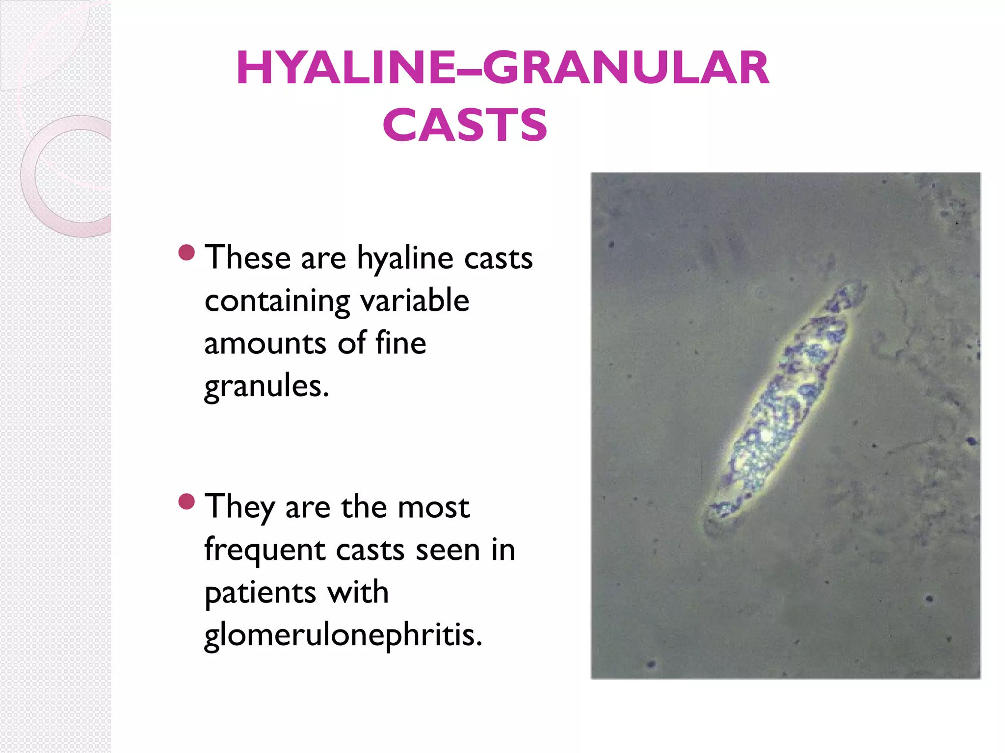 HYALINE–GRANULAR
CASTS
These

are hyaline casts
containing variable
amounts of fine
granules.

They

are the most
frequent casts seen in
patients with
glomerulonephritis.

 