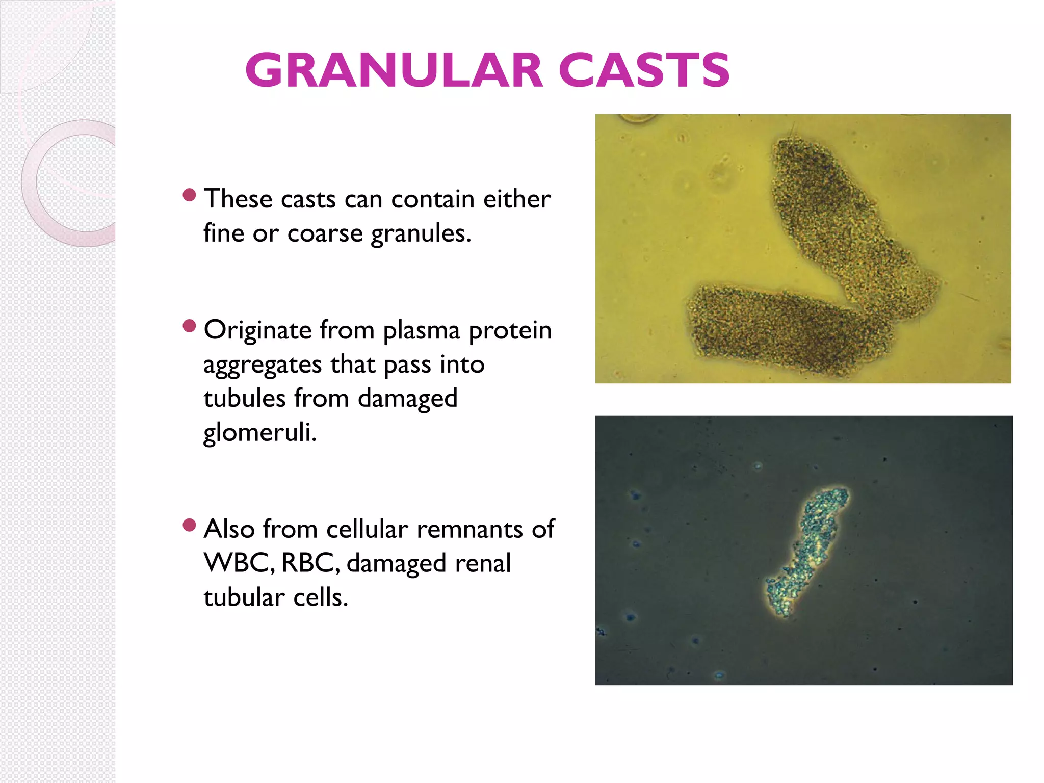 GRANULAR CASTS
These

casts can contain either
fine or coarse granules.

Originate

from plasma protein
aggregates that pass into
tubules from damaged
glomeruli.

Also

from cellular remnants of
WBC, RBC, damaged renal
tubular cells.

 