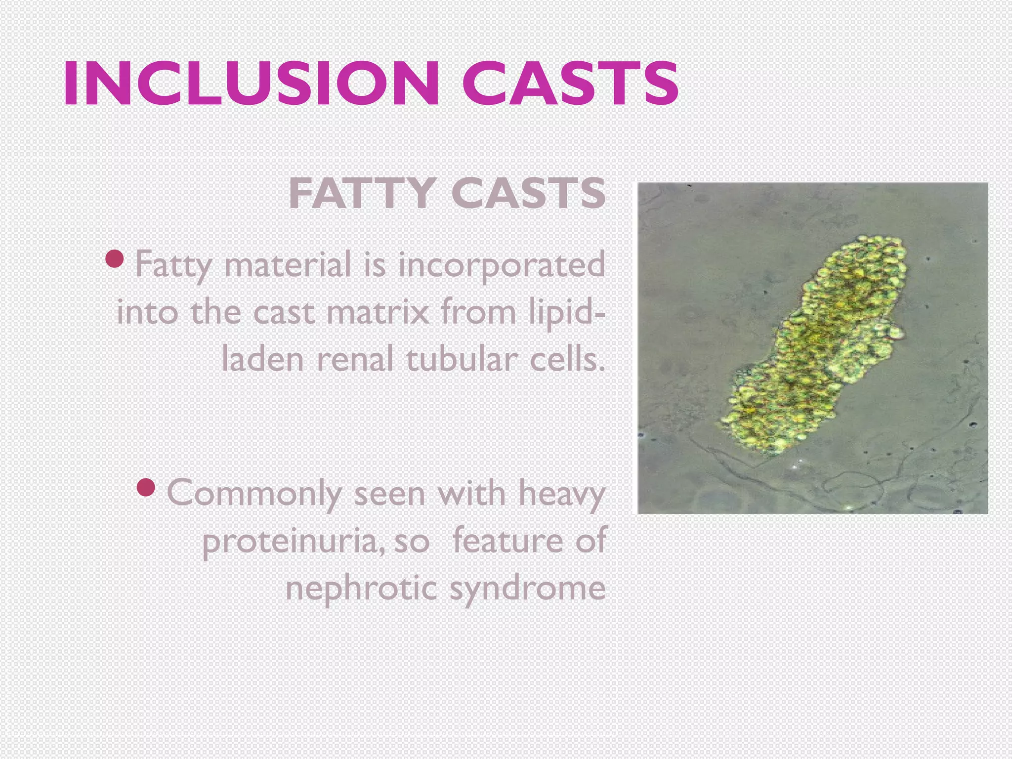 INCLUSION CASTS
FATTY CASTS
Fatty

material is incorporated
into the cast matrix from lipidladen renal tubular cells.
Commonly

seen with heavy
proteinuria, so feature of
nephrotic syndrome

 