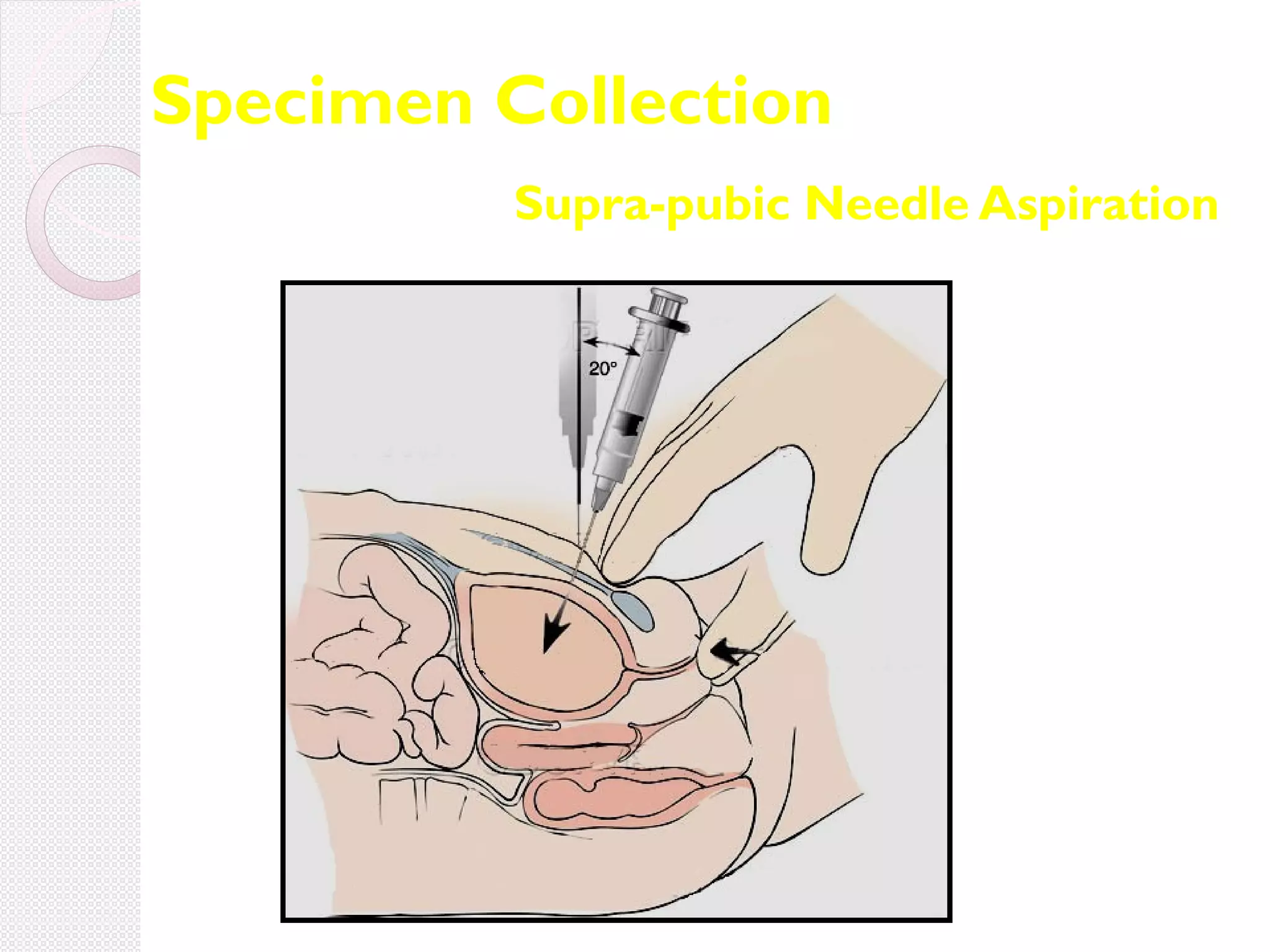 Specimen Collection
Supra-pubic Needle Aspiration

 