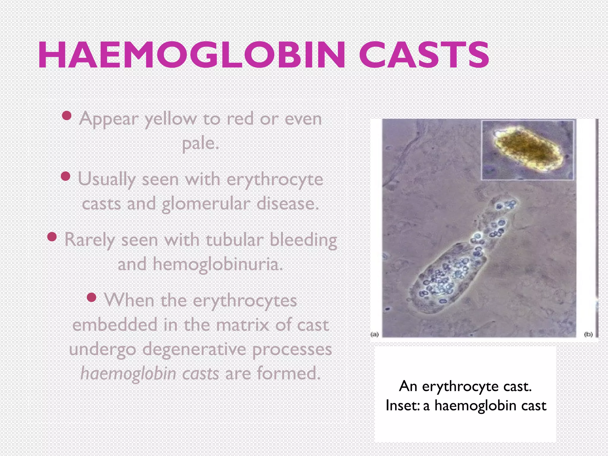 HAEMOGLOBIN CASTS
 Appear

yellow to red or even
pale.

 Usually

seen with erythrocyte
casts and glomerular disease.

 Rarely

seen with tubular bleeding
and hemoglobinuria.

 When

the erythrocytes
embedded in the matrix of cast
undergo degenerative processes
haemoglobin casts are formed.

An erythrocyte cast.
Inset: a haemoglobin cast

 