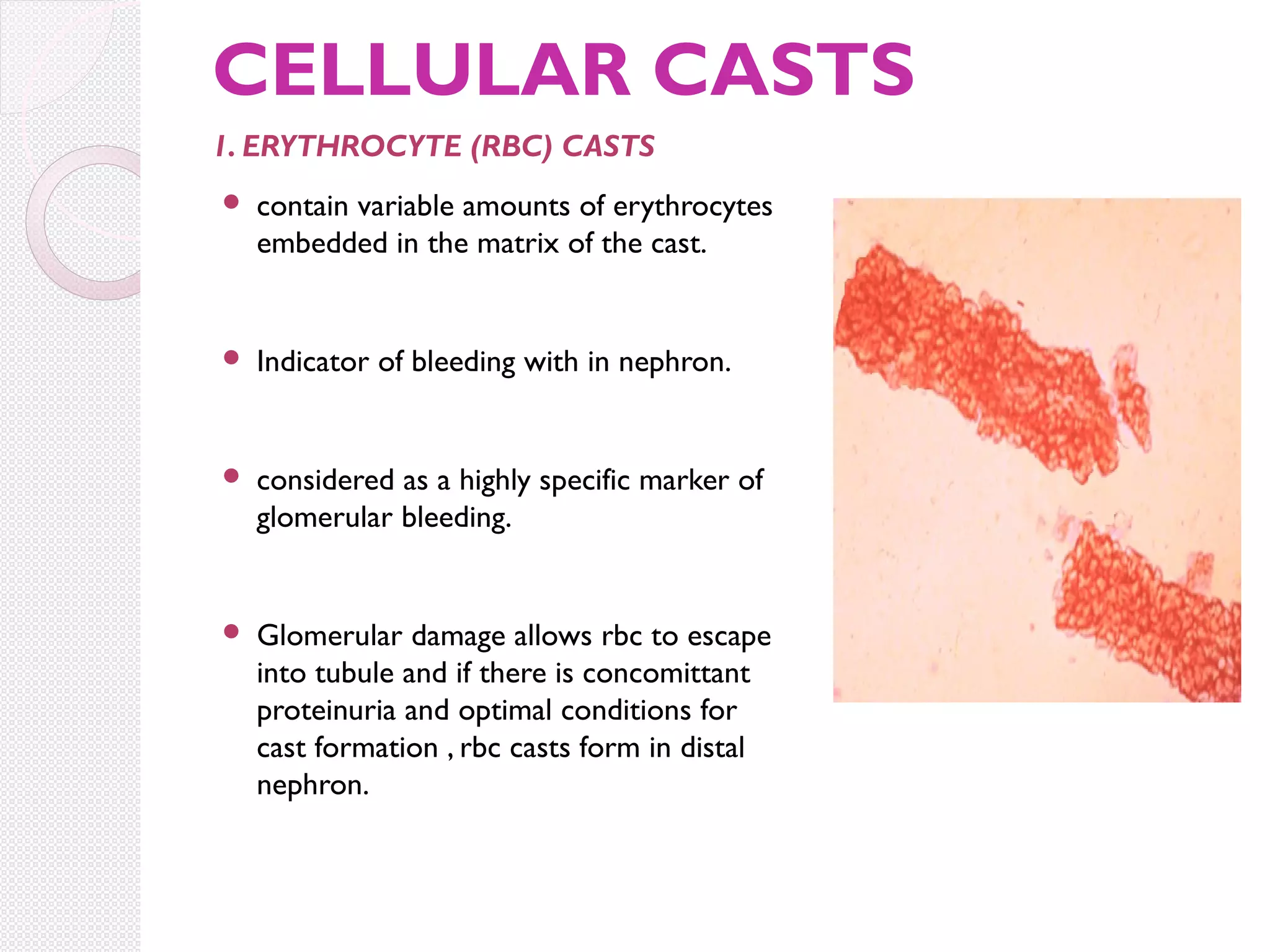 CELLULAR CASTS
1. ERYTHROCYTE (RBC) CASTS


contain variable amounts of erythrocytes
embedded in the matrix of the cast.



Indicator of bleeding with in nephron.



considered as a highly specific marker of
glomerular bleeding.



Glomerular damage allows rbc to escape
into tubule and if there is concomittant
proteinuria and optimal conditions for
cast formation , rbc casts form in distal
nephron.

 