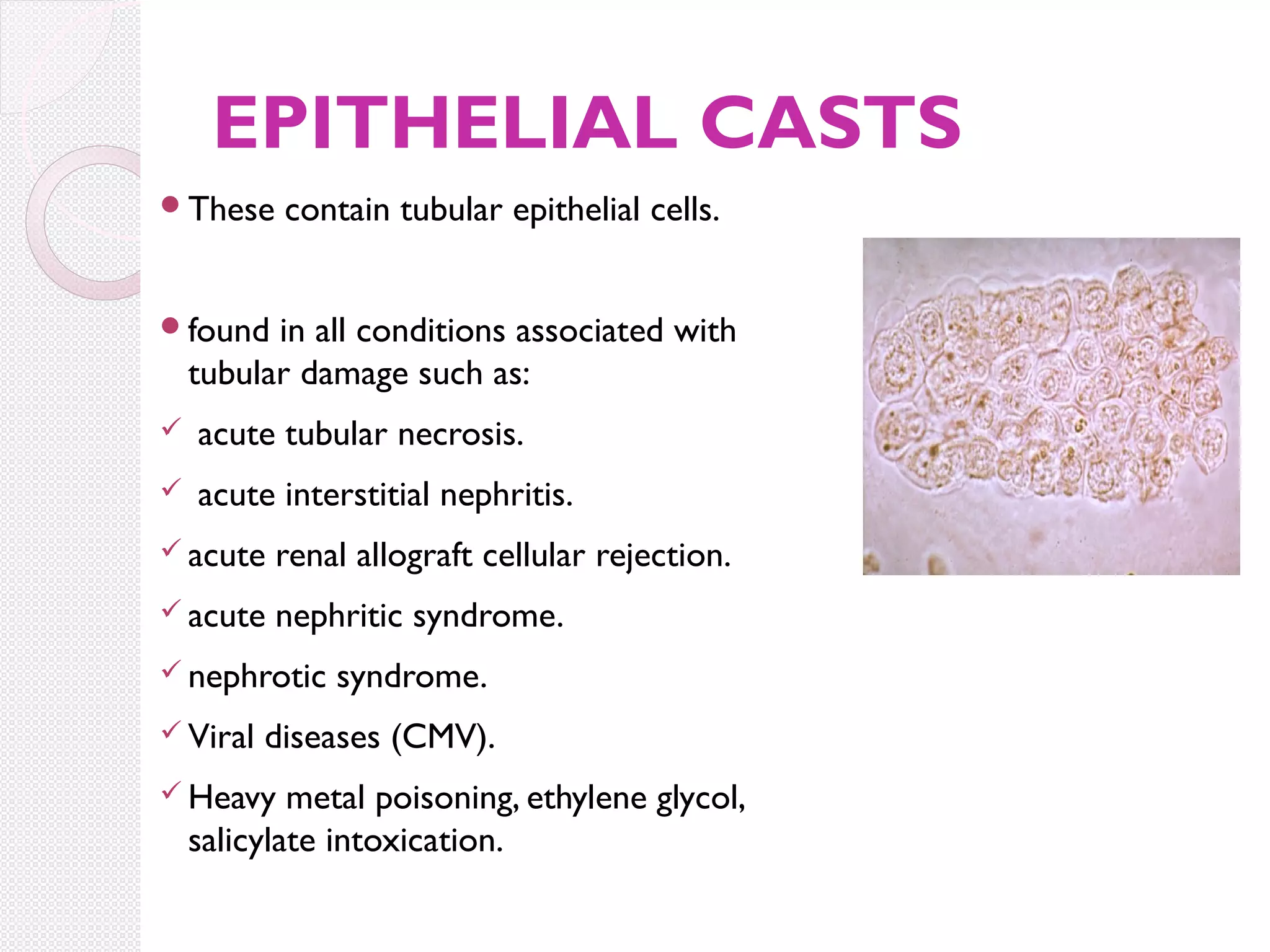 EPITHELIAL CASTS
These

contain tubular epithelial cells.

found

in all conditions associated with
tubular damage such as:



acute tubular necrosis.



acute interstitial nephritis.

 acute

renal allograft cellular rejection.

 acute

nephritic syndrome.

 nephrotic
 Viral

syndrome.

diseases (CMV).

 Heavy

metal poisoning, ethylene glycol,
salicylate intoxication.

 