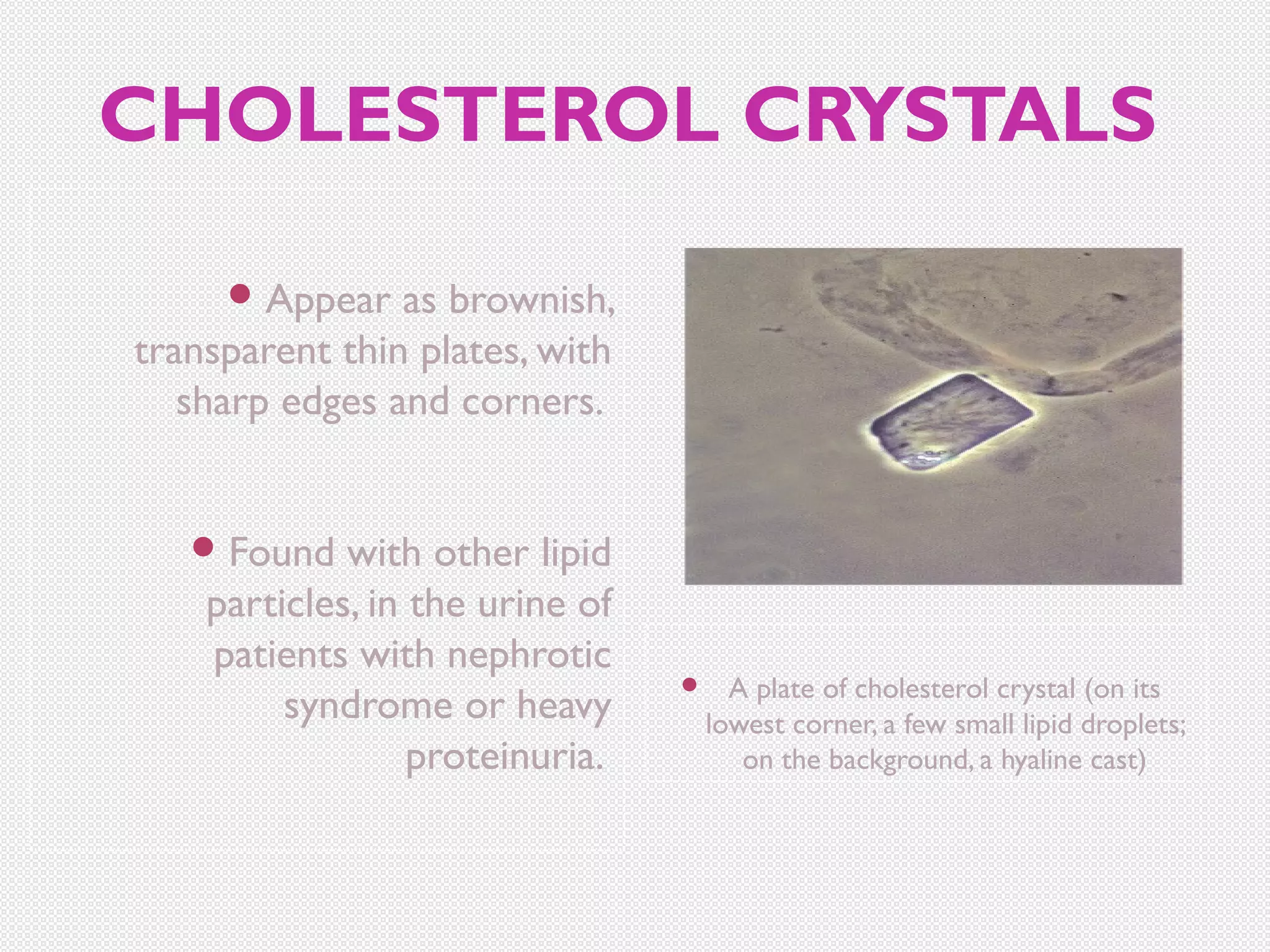 CHOLESTEROL CRYSTALS
 Appear

as brownish,
transparent thin plates, with
sharp edges and corners.
 Found

with other lipid
particles, in the urine of
patients with nephrotic
syndrome or heavy
proteinuria.



A plate of cholesterol crystal (on its
lowest corner, a few small lipid droplets;
on the background, a hyaline cast)

 