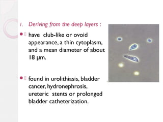 1.

Deriving from the deep layers :

.

have club-like or ovoid
appearance, a thin cytoplasm,
and a mean diameter of about
18 μm.

.

found in urolithiasis, bladder
cancer, hydronephrosis,
ureteric stents or prolonged
bladder catheterization.

 