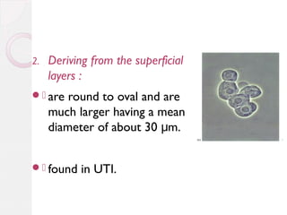 2.

Deriving from the superficial
layers :

. are

round to oval and are
much larger having a mean
diameter of about 30 μm.

. found

in UTI.

 