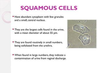 SQUAMOUS CELLS
Have

abundant cytoplasm with few granules
and a small, central nucleus.

They

are the largest cells found in the urine,
with a mean diameter of about 55 μm.

They

are found routinely in small numbers,
being exfoliated from the urethra.

When

found in large numbers, they indicate a
contamination of urine from vaginal discharge.

 