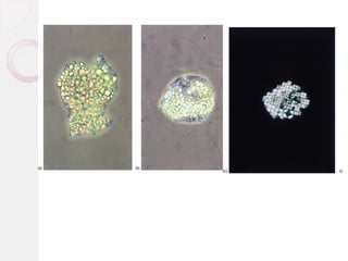 (a) A large aggregate of lipid droplets.
(b) A macrophage partly gorged with lipid droplets (a so-called 'oval fat body').
(c) Maltese crosses

 